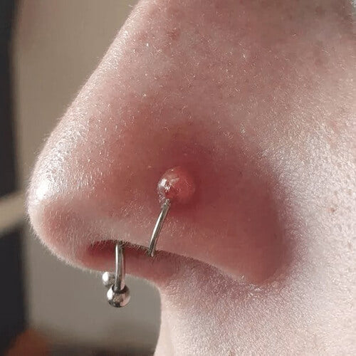 Nose piercing with granuloma